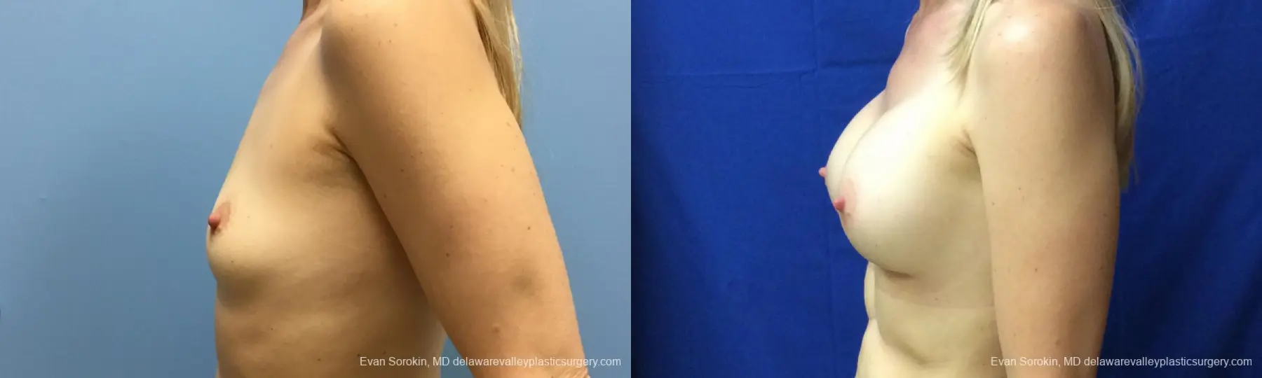 Philadelphia Breast Augmentation 12520 - Before and After 5