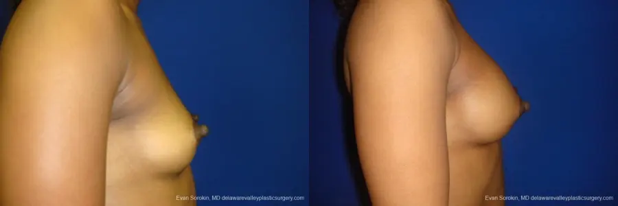 Philadelphia Breast Augmentation 8665 - Before and After 4