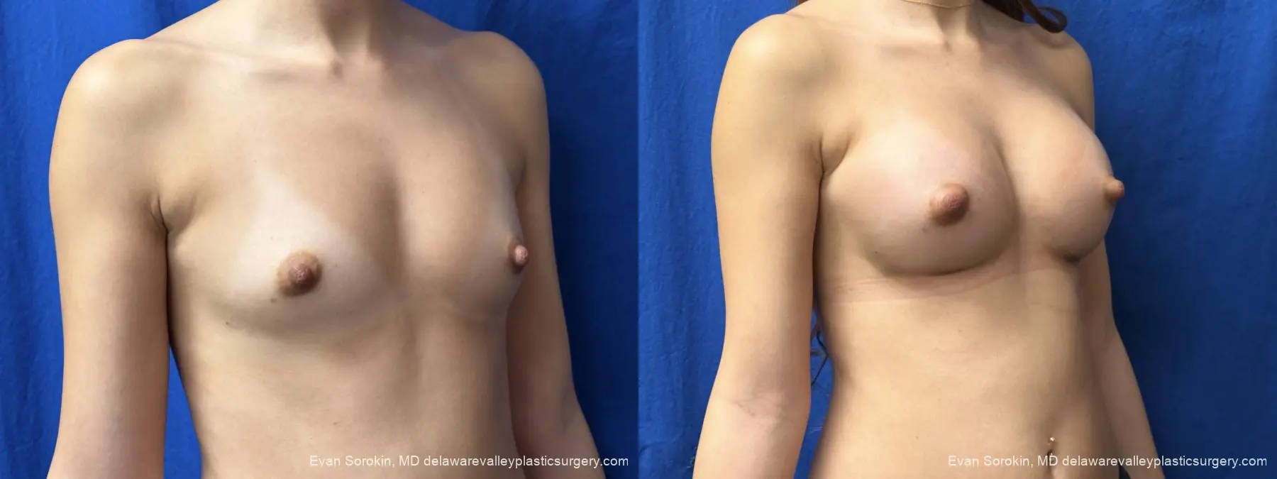 Breast Augmentation: Patient 2 - Before and After 2