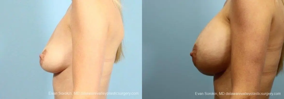 Philadelphia Breast Augmentation 8782 - Before and After 5