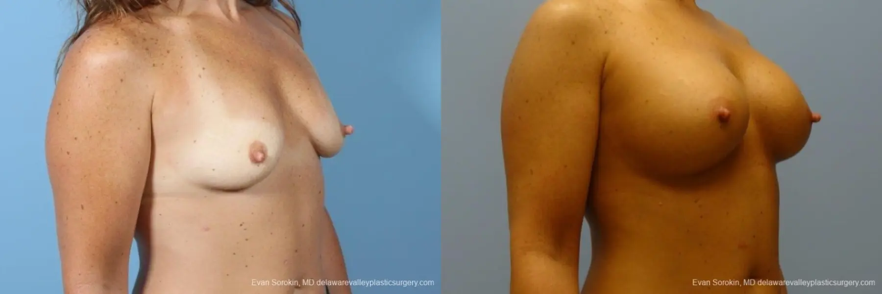 Philadelphia Breast Augmentation 8774 - Before and After 2