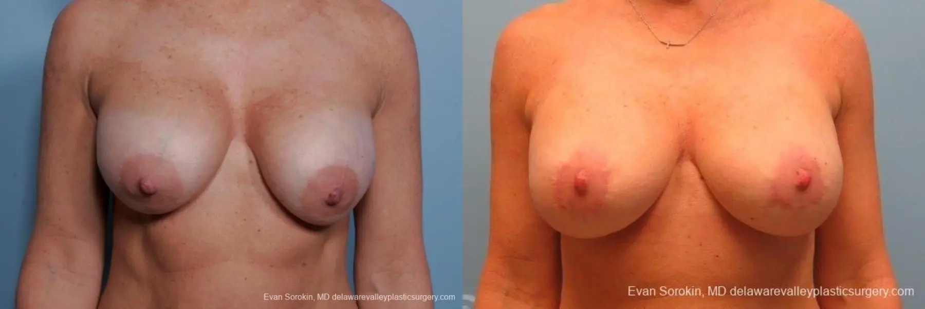 Philadelphia Breast Augmentation 8693 - Before and After 1