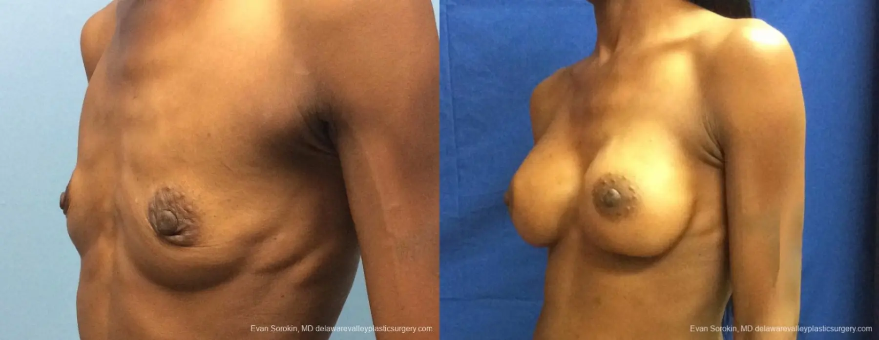 Philadelphia Breast Augmentation 13072 - Before and After 4