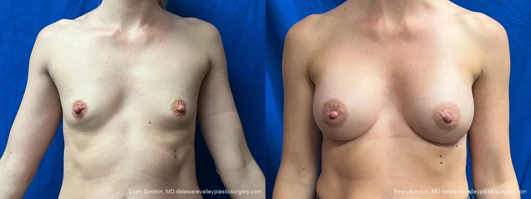 Breast Augmentation: Patient 10 - Before and After