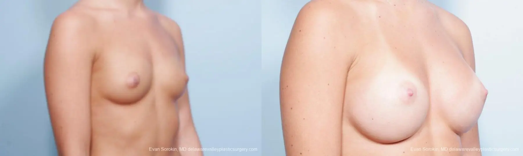 Philadelphia Breast Augmentation 9304 - Before and After 2