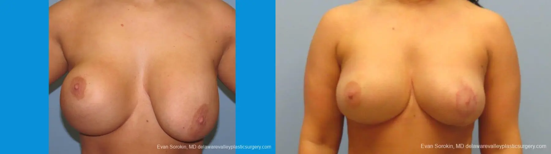 Philadelphia Breast Augmentation 10089 - Before and After 1