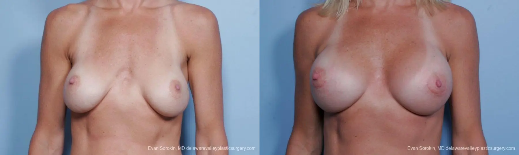 Philadelphia Breast Augmentation 9454 - Before and After