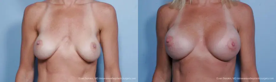Philadelphia Breast Augmentation 9454 - Before and After 1