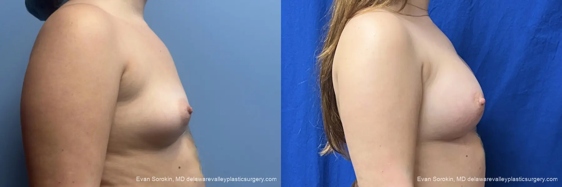 Breast Augmentation: Patient 340 - Before and After 3