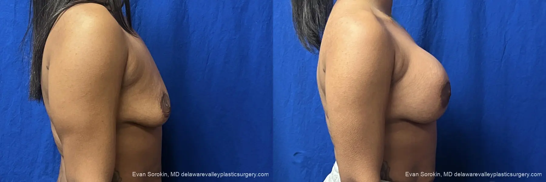 Breast Augmentation: Patient 271 - Before and After 3