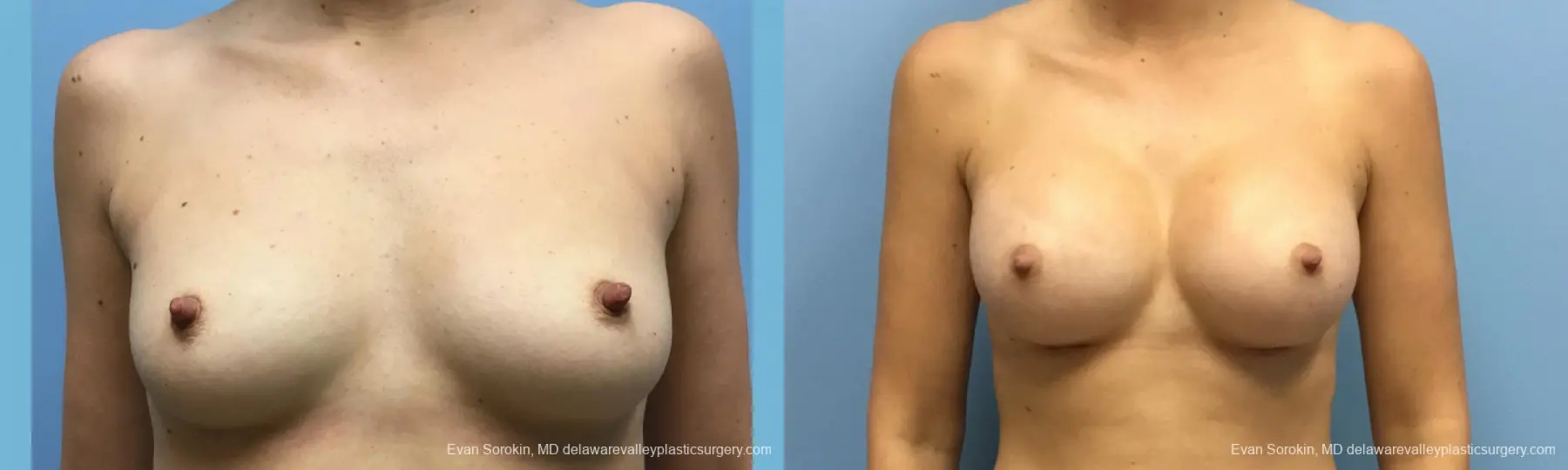 Philadelphia Breast Augmentation 12514 - Before and After 1