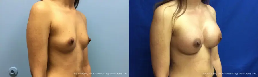 Philadelphia Breast Augmentation 12515 - Before and After 2