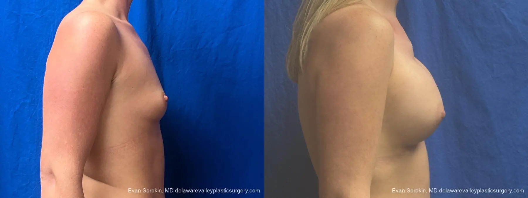 Breast Augmentation: Patient 328 - Before and After 3