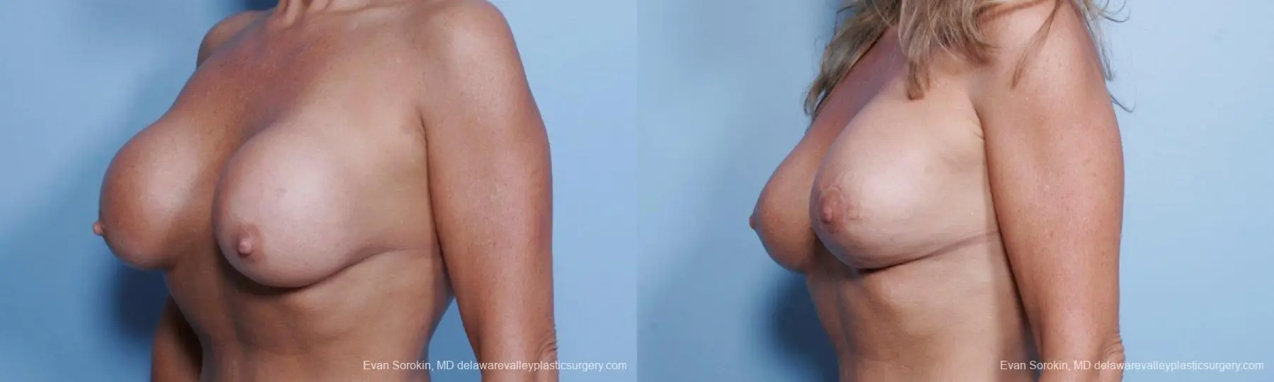 Philadelphia Breast Augmentation 9452 - Before and After 3