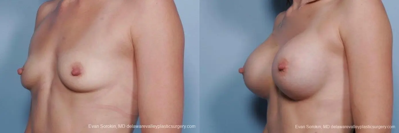 Philadelphia Breast Augmentation 8767 - Before and After 3