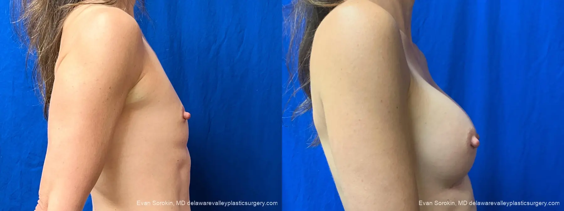 Breast Augmentation: Patient 325 - Before and After 3