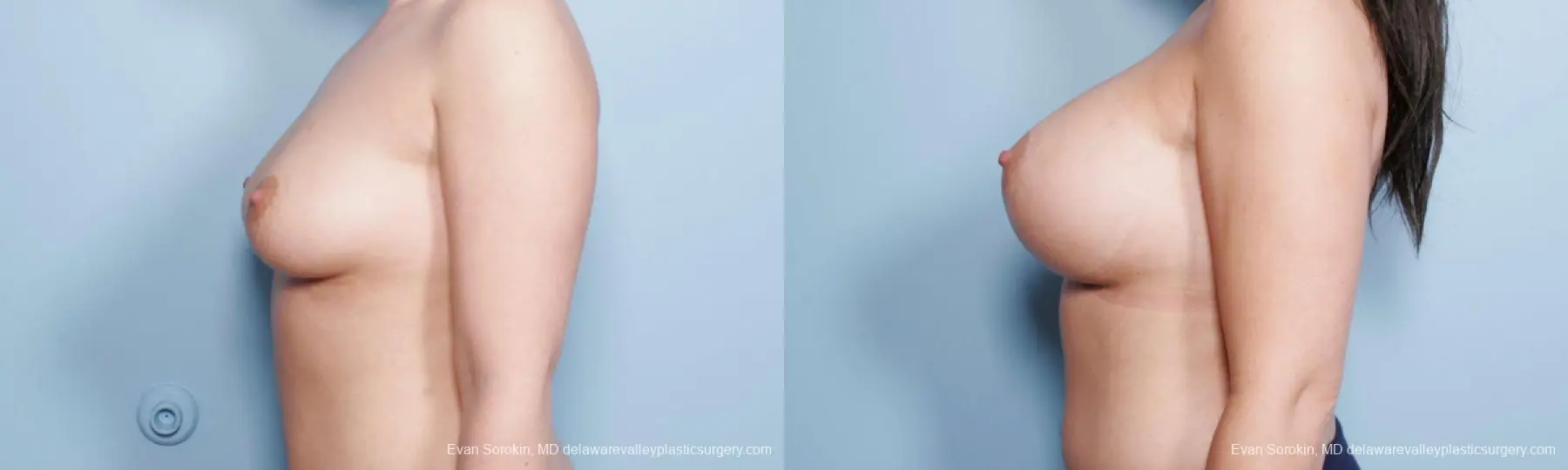 Philadelphia Breast Augmentation 9172 - Before and After 5