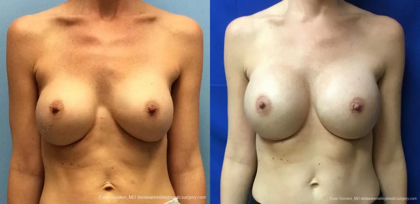 Philadelphia Breast Augmentation 13069 - Before and After 1