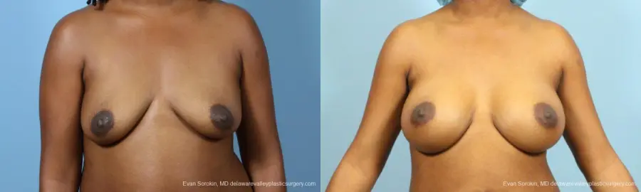 Philadelphia Breast Augmentation 9173 - Before and After 1