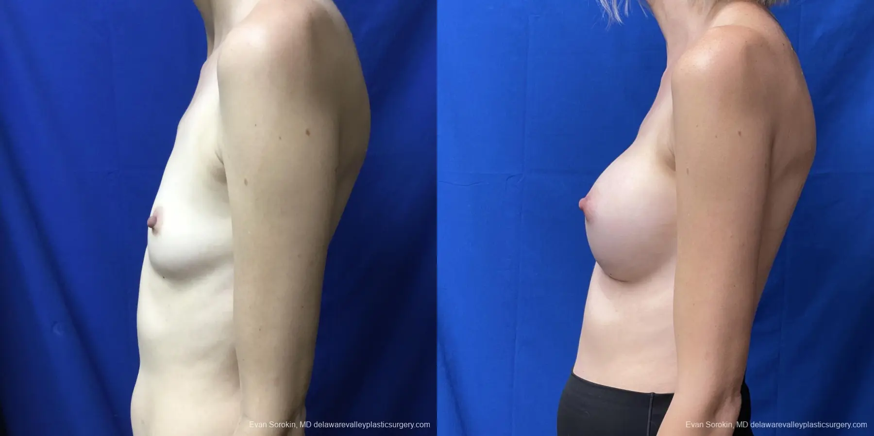 Breast Augmentation: Patient 204 - Before and After 5