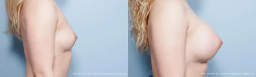 Breast Augmentation: Patient 129 - Before and After 3