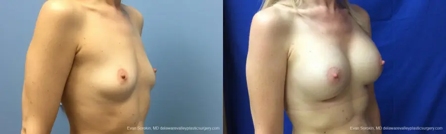 Philadelphia Breast Augmentation 12520 - Before and After 2