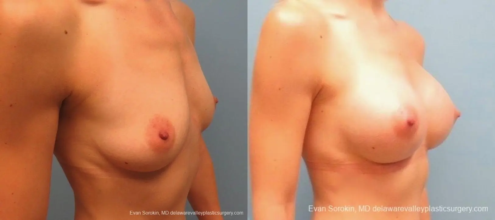 Philadelphia Breast Augmentation 8823 - Before and After 2