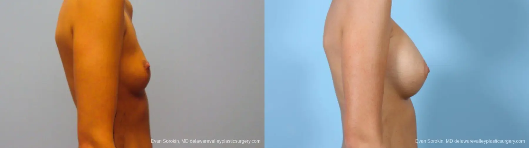 Philadelphia Breast Augmentation 9292 - Before and After 5