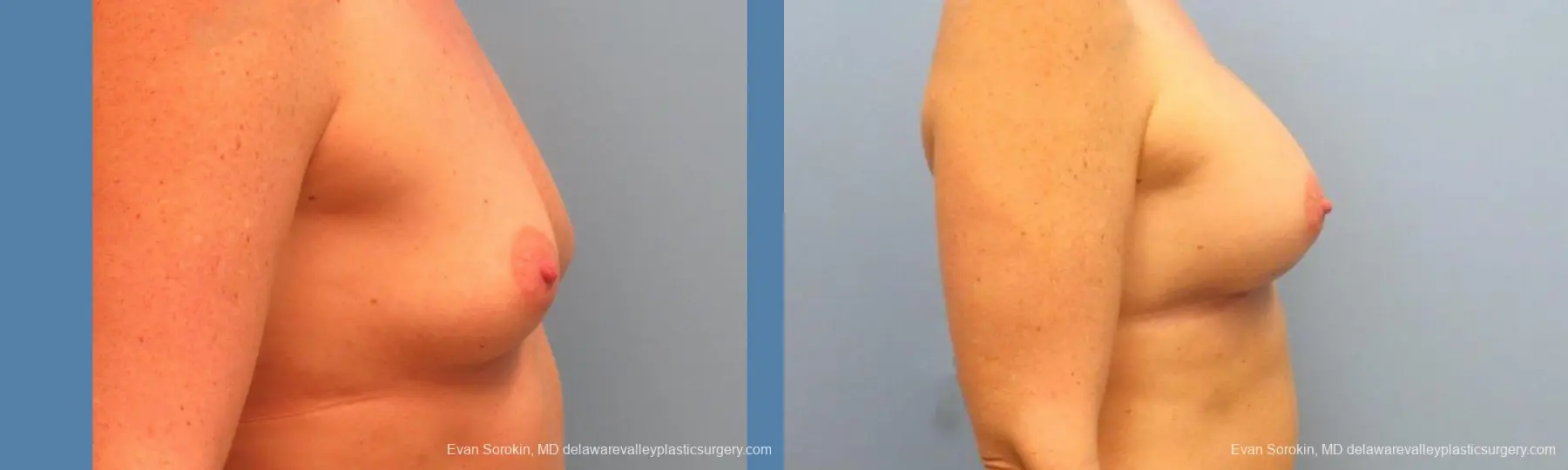 Philadelphia Breast Augmentation 9487 - Before and After 3