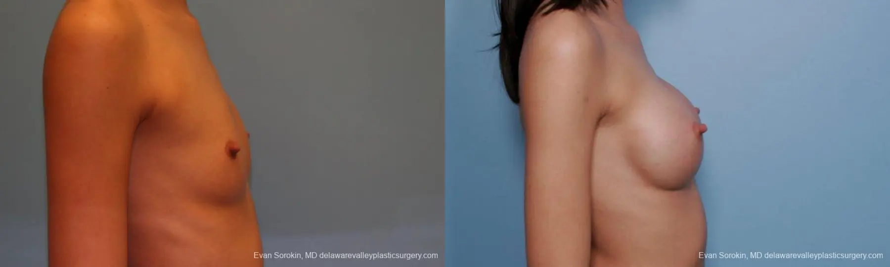 Philadelphia Breast Augmentation 9377 - Before and After 3