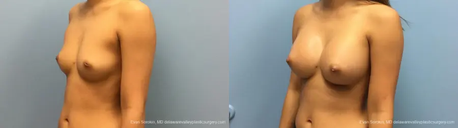 Philadelphia Breast Augmentation 13183 - Before and After 4