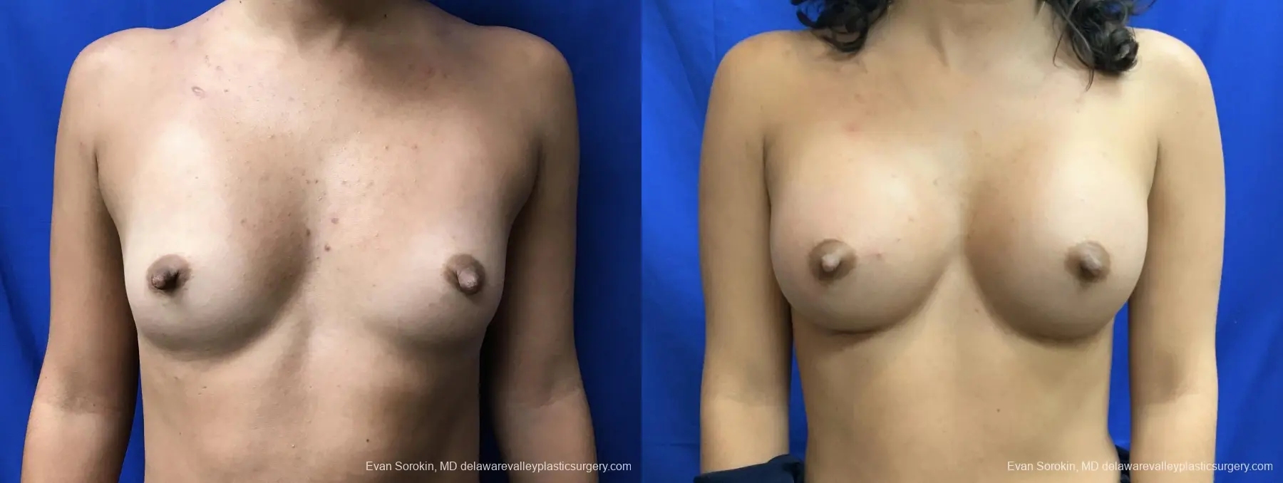 Breast Augmentation: Patient 210 - Before and After 1