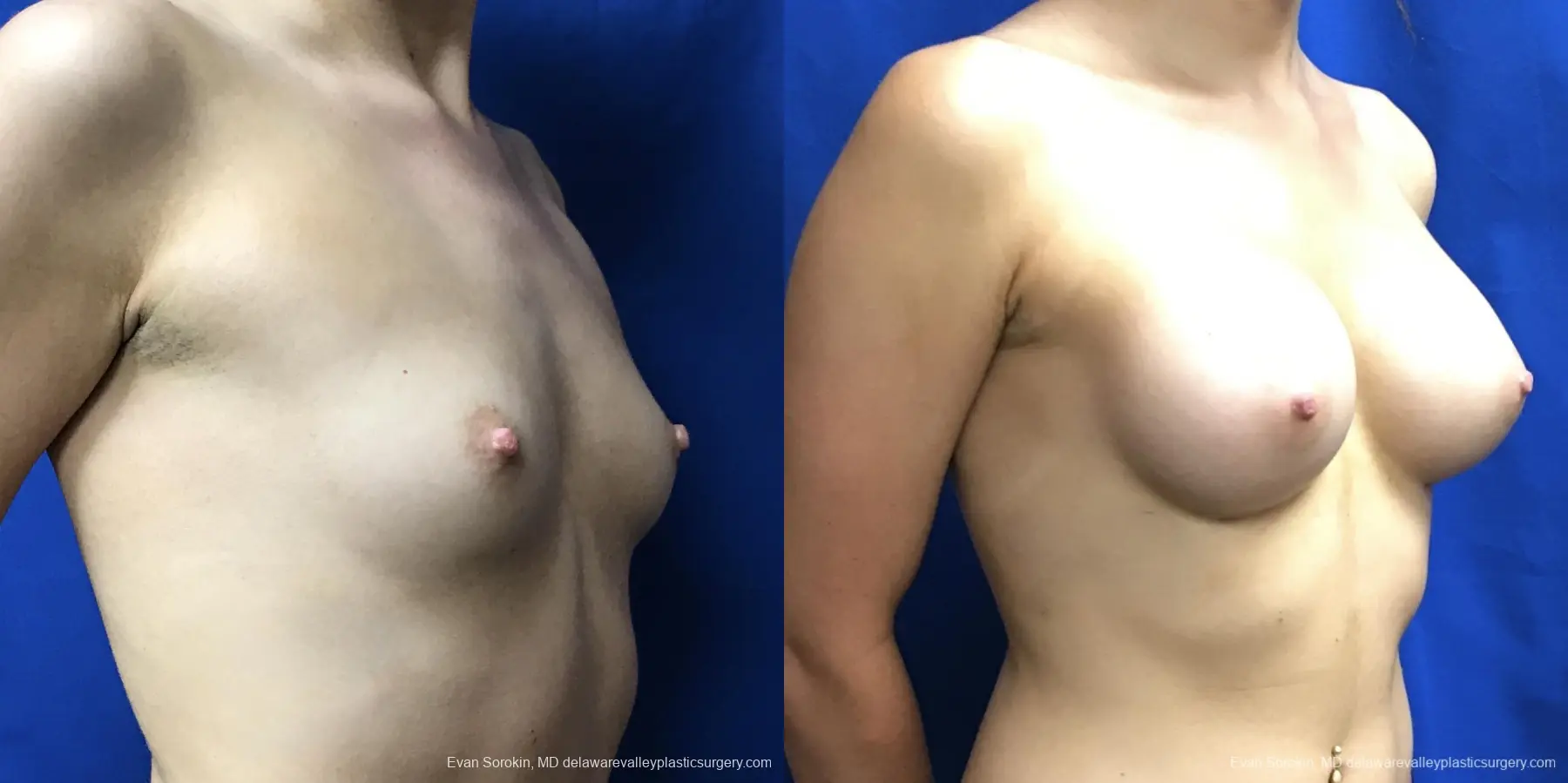 Breast Augmentation: Patient 170 - Before and After 2