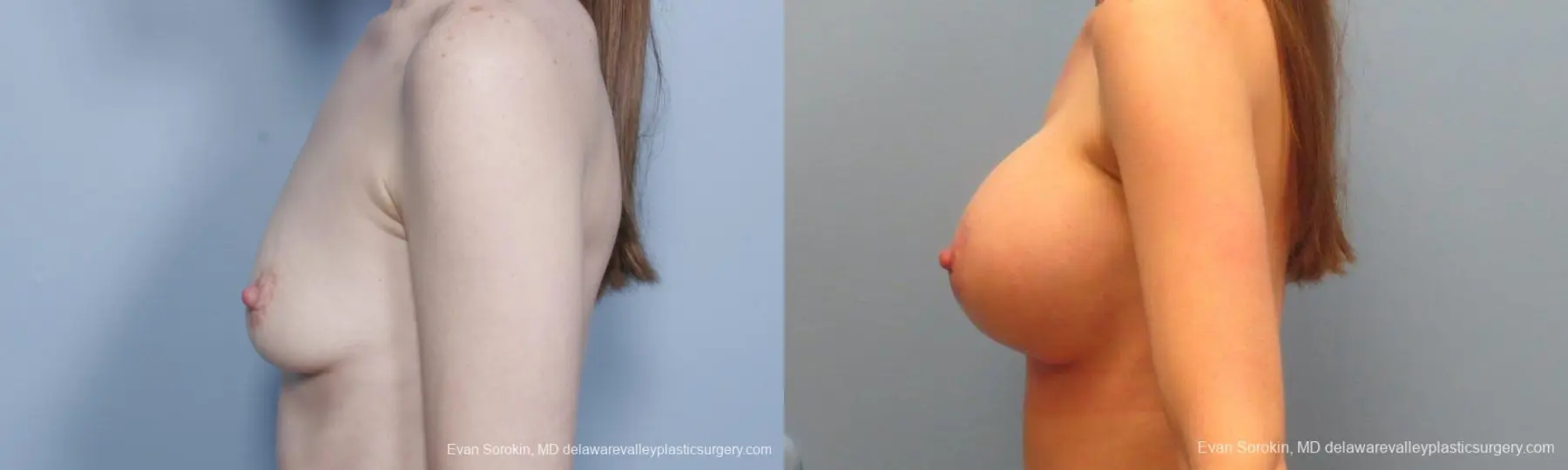 Philadelphia Breast Augmentation 8781 - Before and After 5