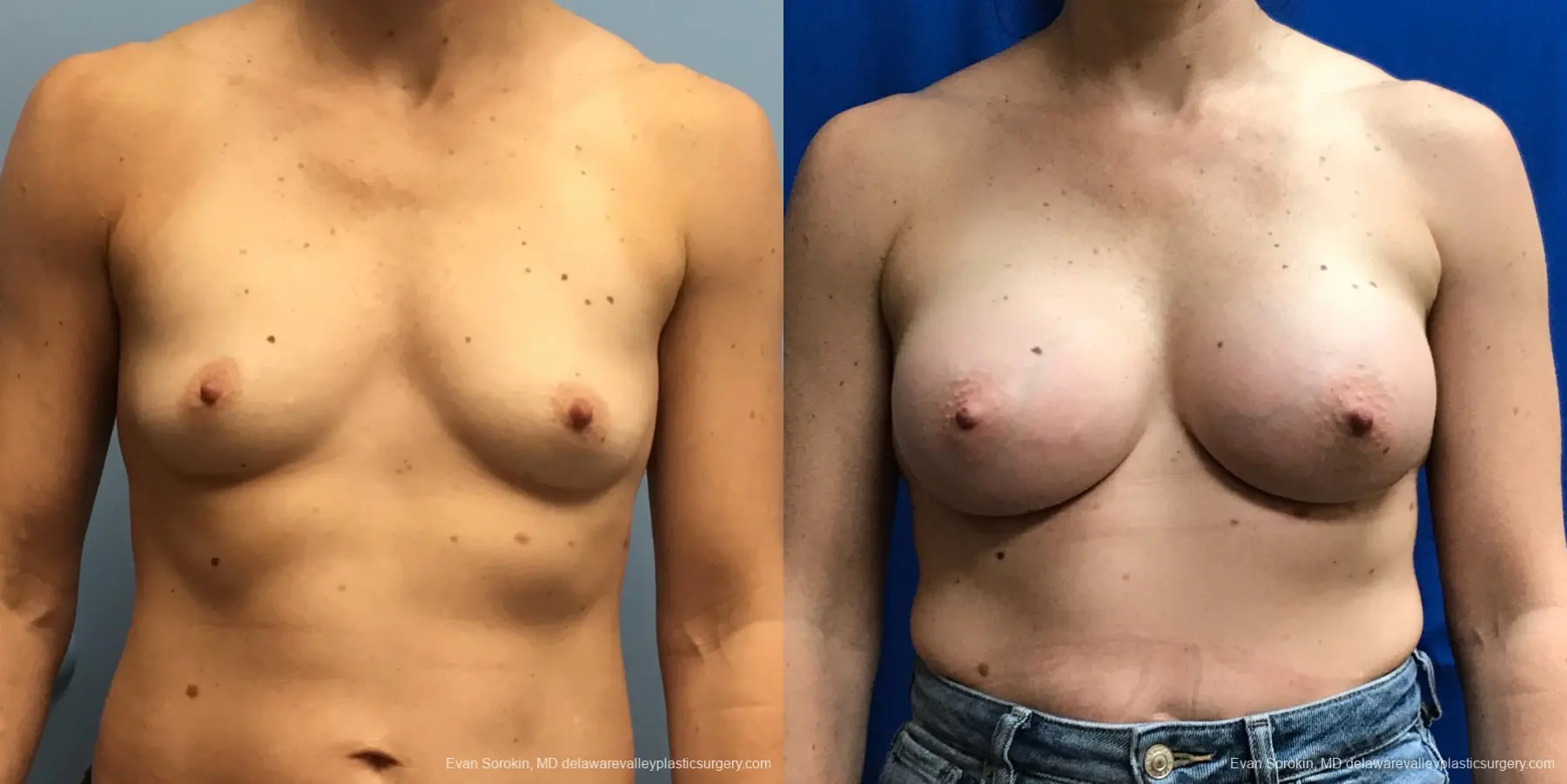 Breast Augmentation: Patient 216 - Before and After 1