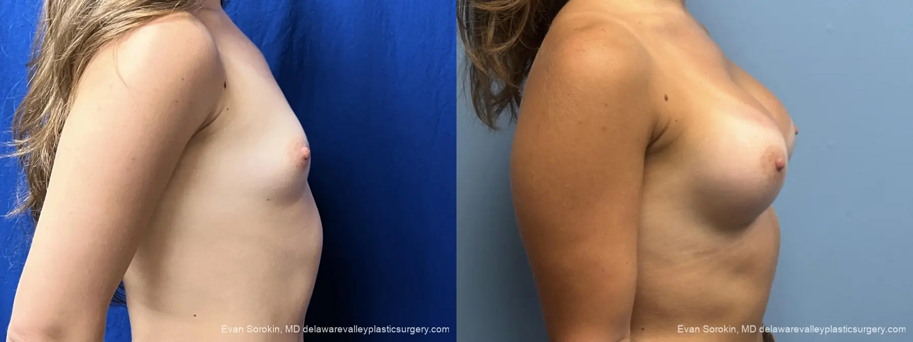 Breast Augmentation: Patient 3 - Before and After 3