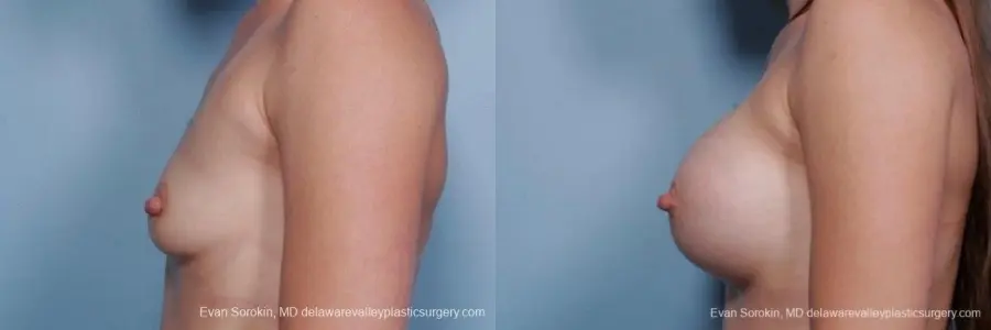Philadelphia Breast Augmentation 8767 - Before and After 5