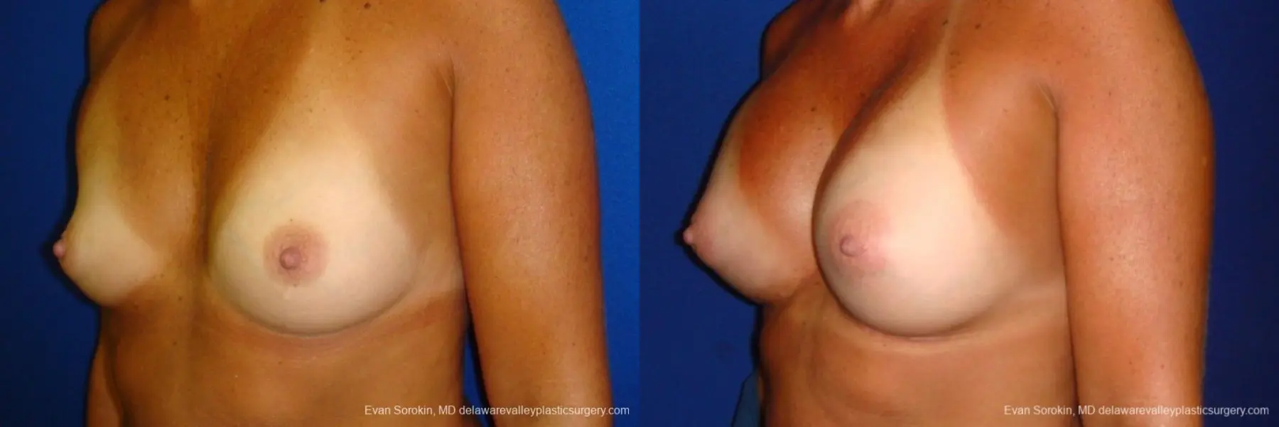 Philadelphia Breast Augmentation 8775 - Before and After 3