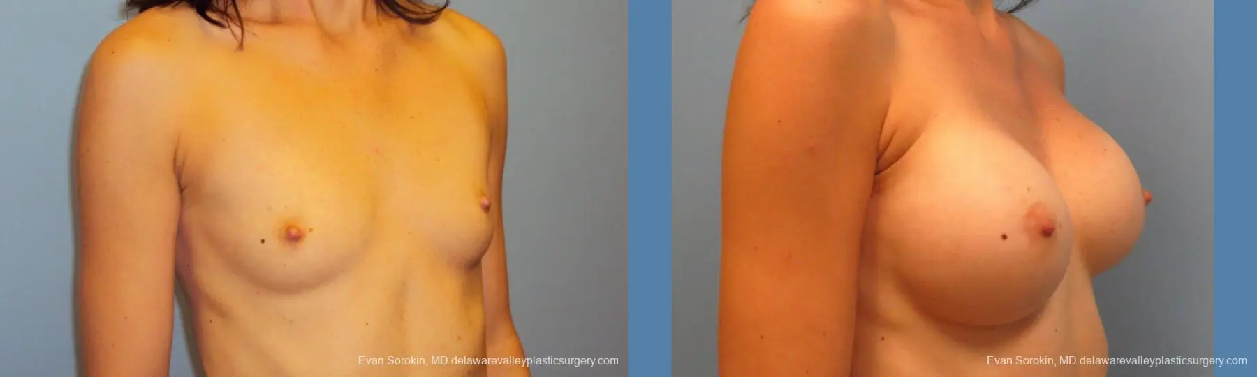 Philadelphia Breast Augmentation 9417 - Before and After 2