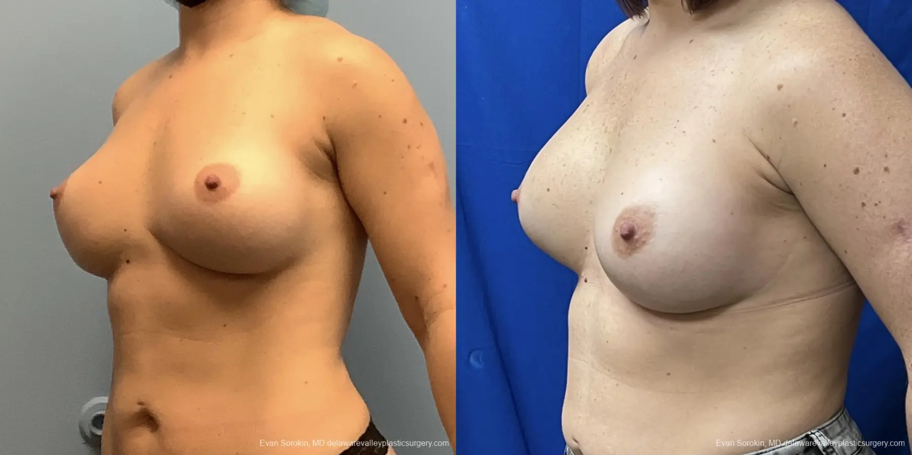 Breast Augmentation: Patient 224 - Before and After 2