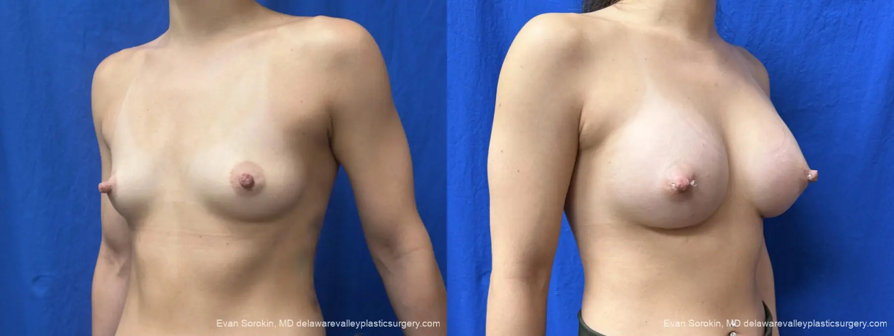 Breast Augmentation: Patient 278 - Before and After 4