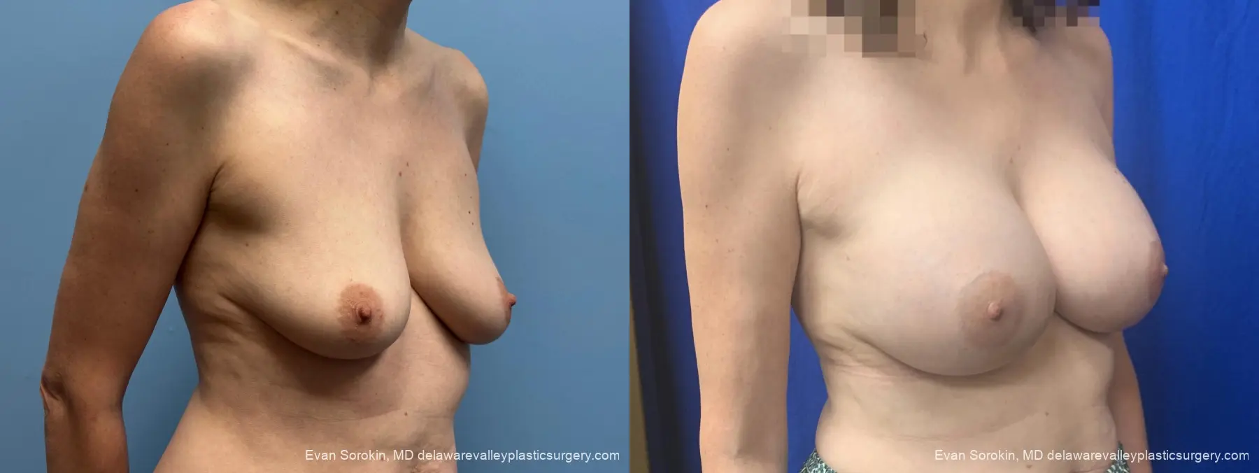 Breast Augmentation: Patient 328 - Before and After 2