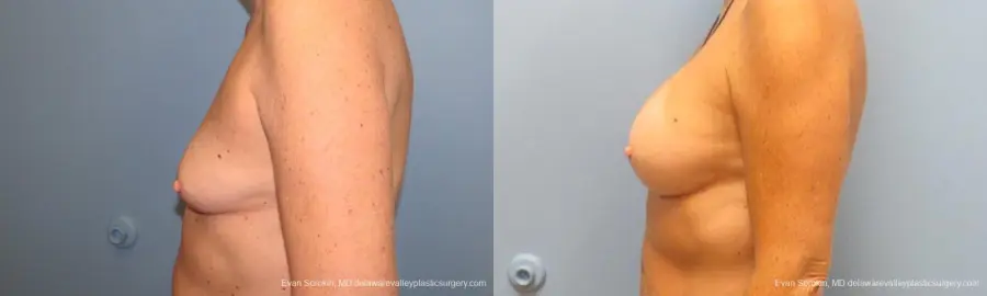 Philadelphia Breast Augmentation 9549 - Before and After 5