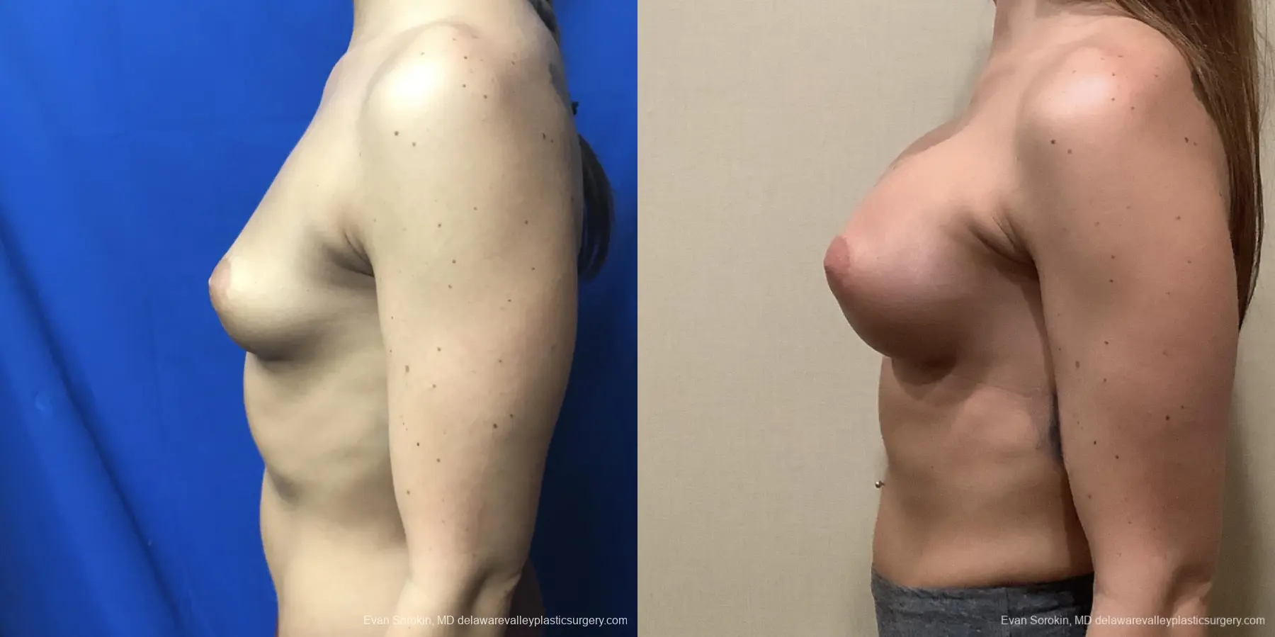 Breast Augmentation: Patient 219 - Before and After 5