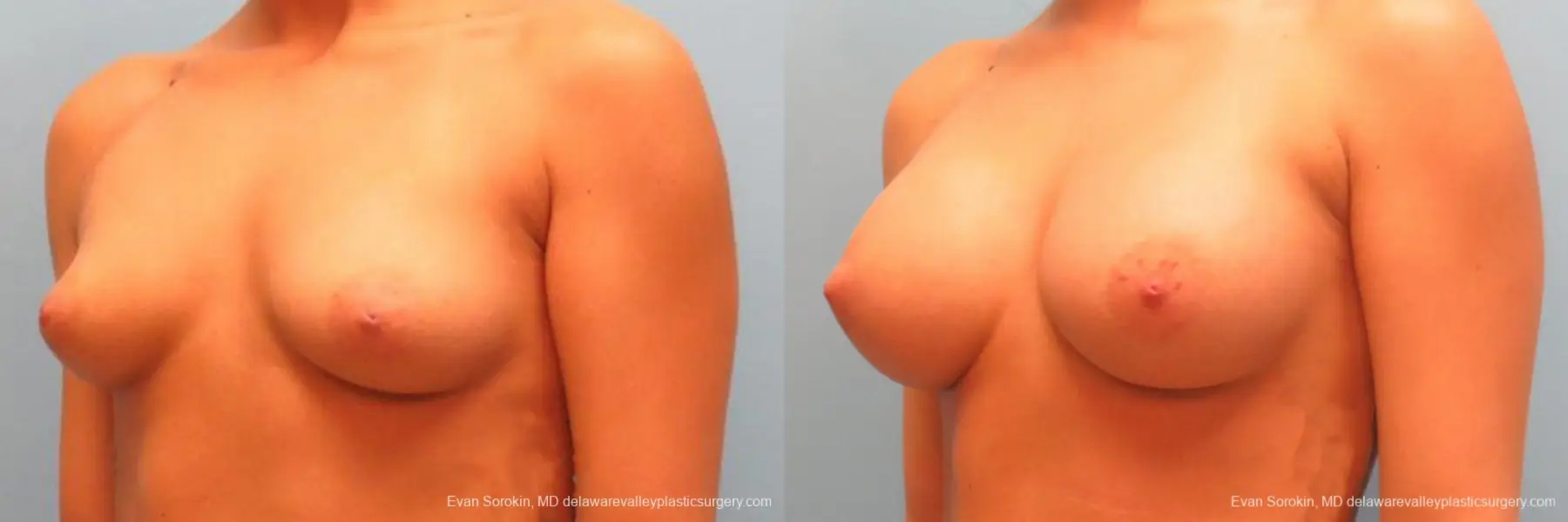 Philadelphia Breast Augmentation 9344 - Before and After 4