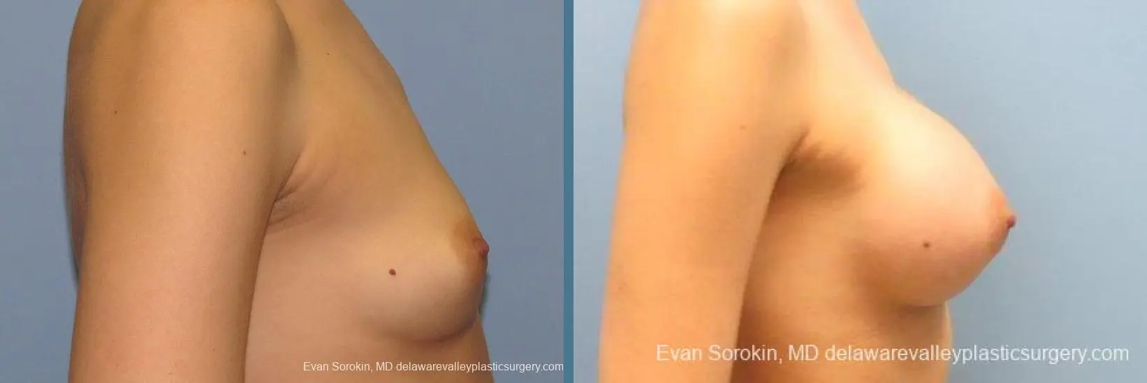 Philadelphia Breast Augmentation 10097 - Before and After 3
