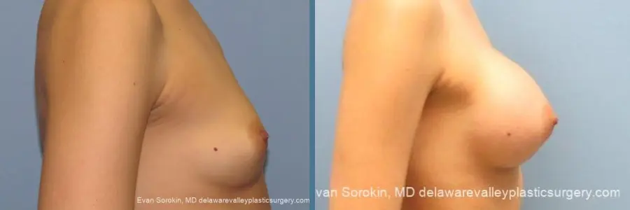Philadelphia Breast Augmentation 10097 - Before and After 3