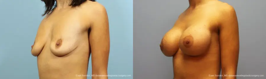 Philadelphia Breast Augmentation 9205 - Before and After 4