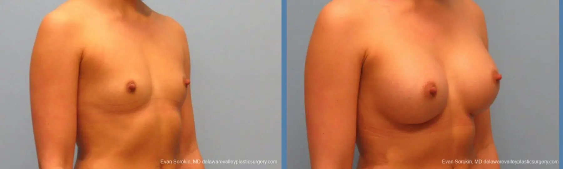 Philadelphia Breast Augmentation 9410 - Before and After 2