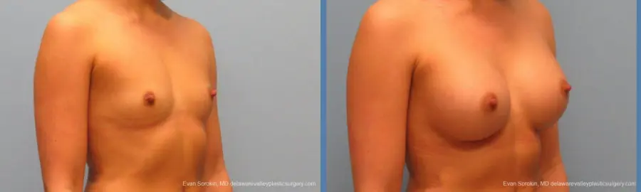 Philadelphia Breast Augmentation 9410 - Before and After 2
